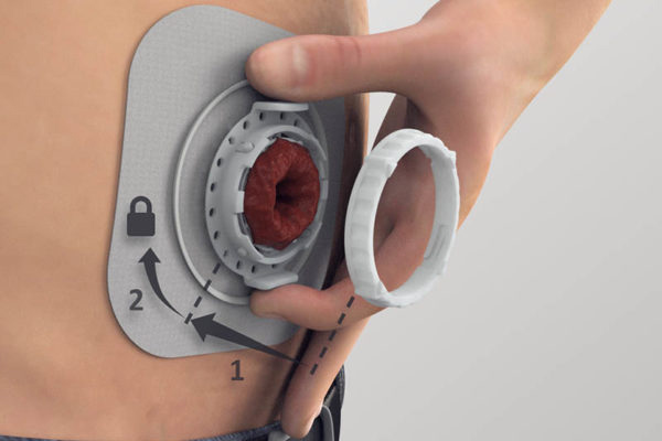 OstomySecure clinical trial across five countries